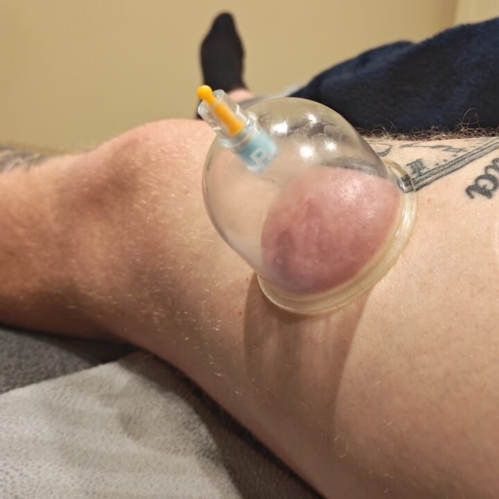 Dry cupping therapy treatment
